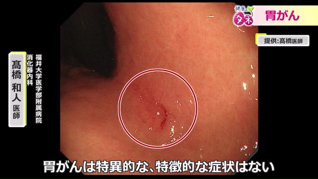 胃がんは無症状の場合も